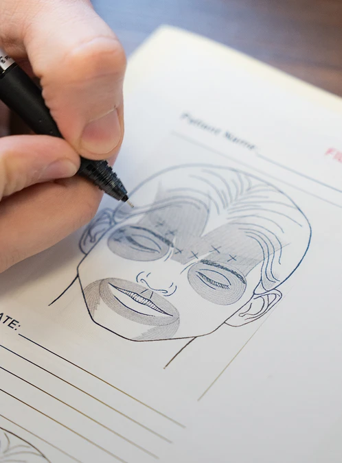 A close-up shot of a person using a black fine-tip pen to draw markings and shaded areas on a paper medical diagram of a human face. - Injectables in Los Angeles, CA