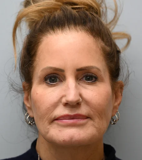 2-Pre-op Frontal-cropped