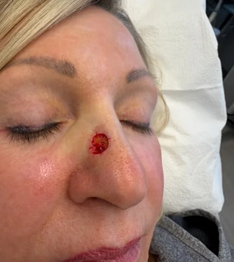 2-Pre-op R Quarter-cropped