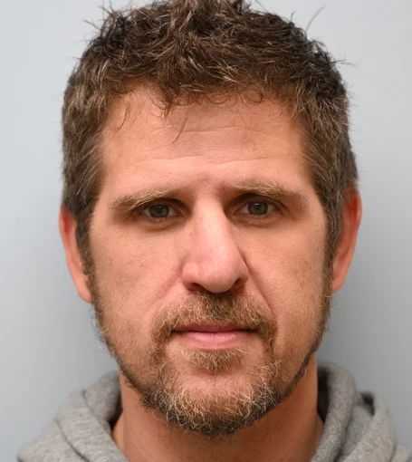 3-Pre-op Frontal-cropped