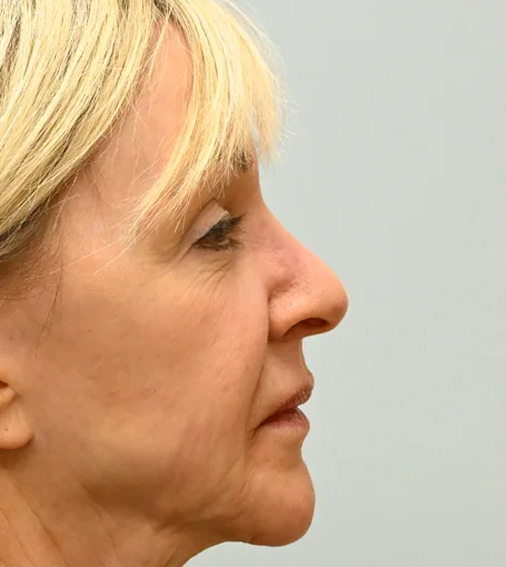 PO 3mo R Profile-cropped