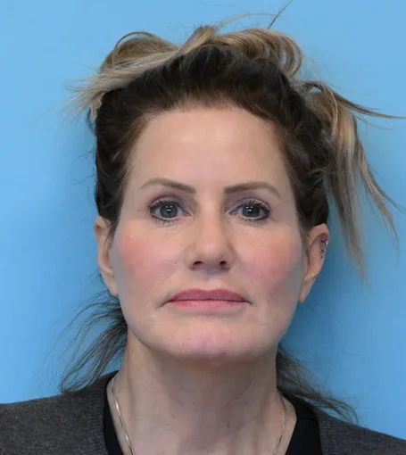 PO 6wks Frontal-cropped