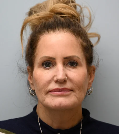 Pre-op Frontal-cropped