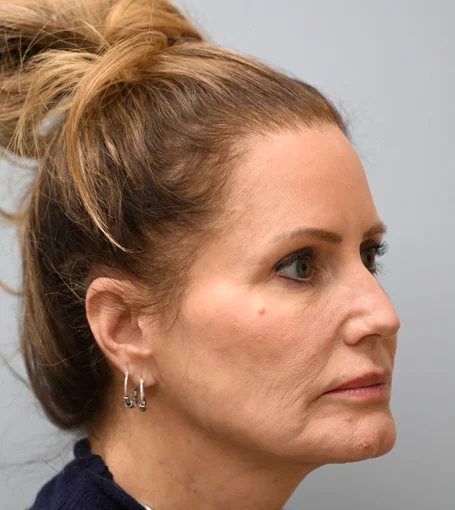 Pre-op R Quarter-cropped