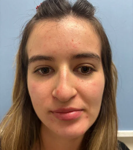 Preop Frontal-cropped