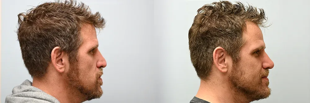 rhino-p03-R-profile copy
