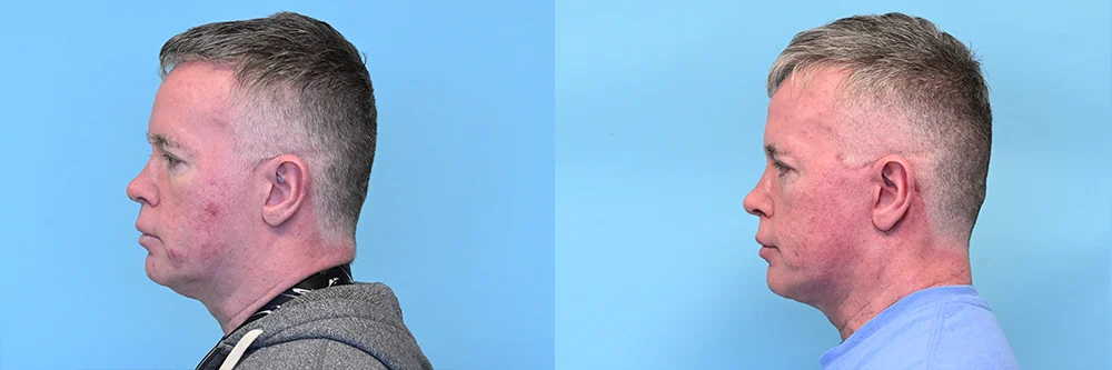 Face-Neck-Lift_p01-02