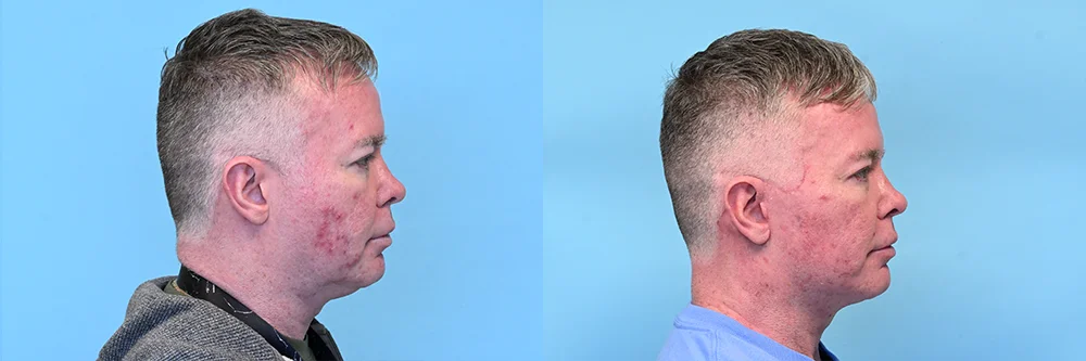 Face-Neck-Lift_p01-03