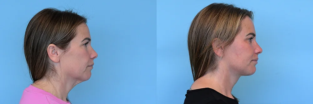 deep plane face and neck lift-p01-01