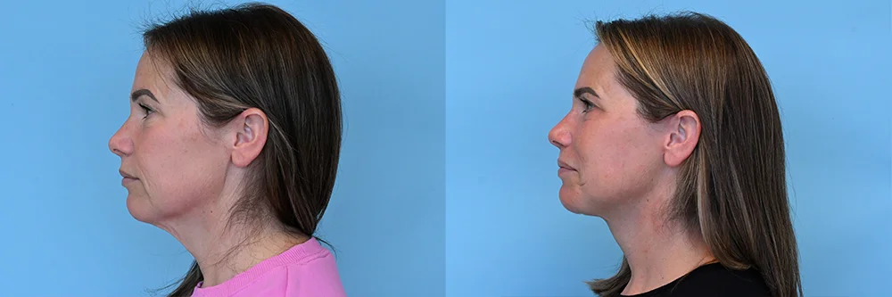 deep plane face and neck lift-p01-02