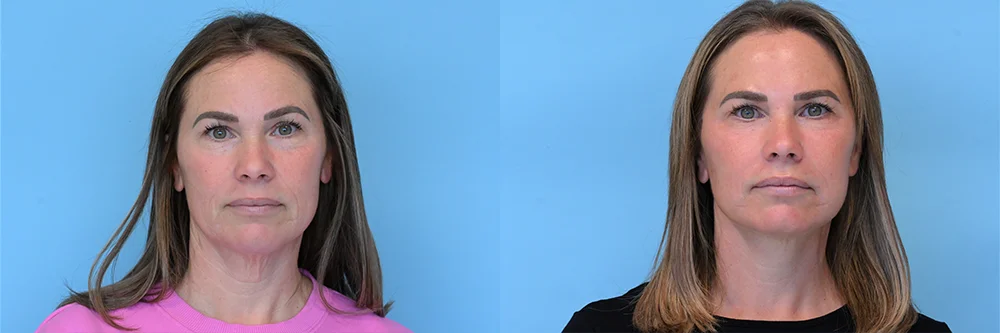 deep plane face and neck lift-p01-03