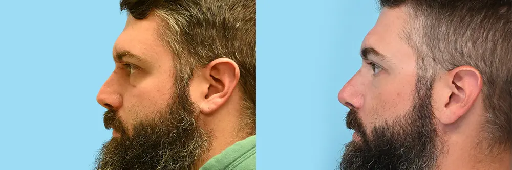 rhinoplasty scar -05_2