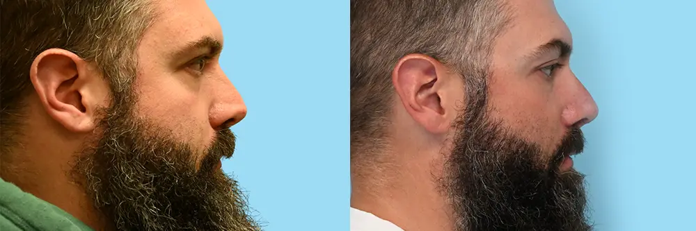 rhinoplasty scar -05_3