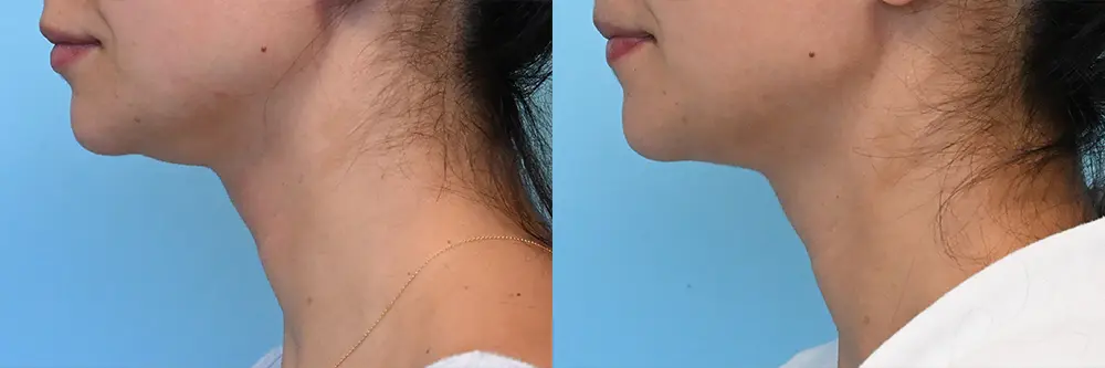 p1_submental liposuction_01