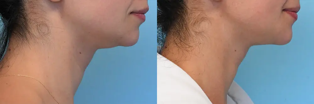 p1_submental liposuction_02