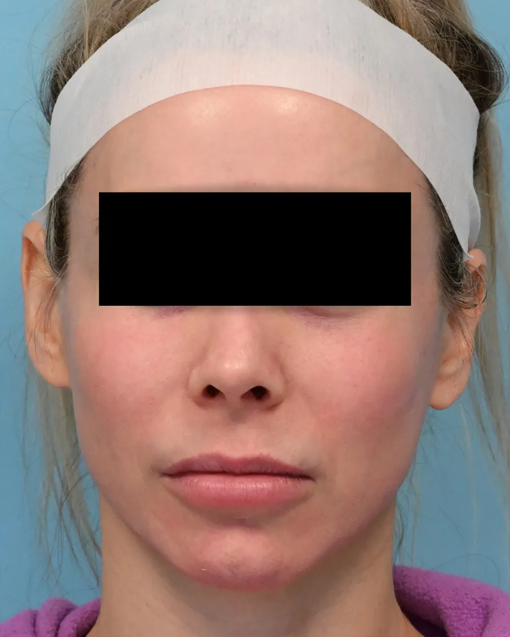 p3-liplift-01