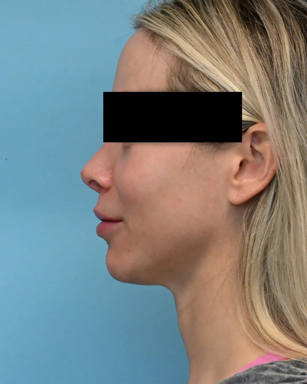 p3-liplift-02a