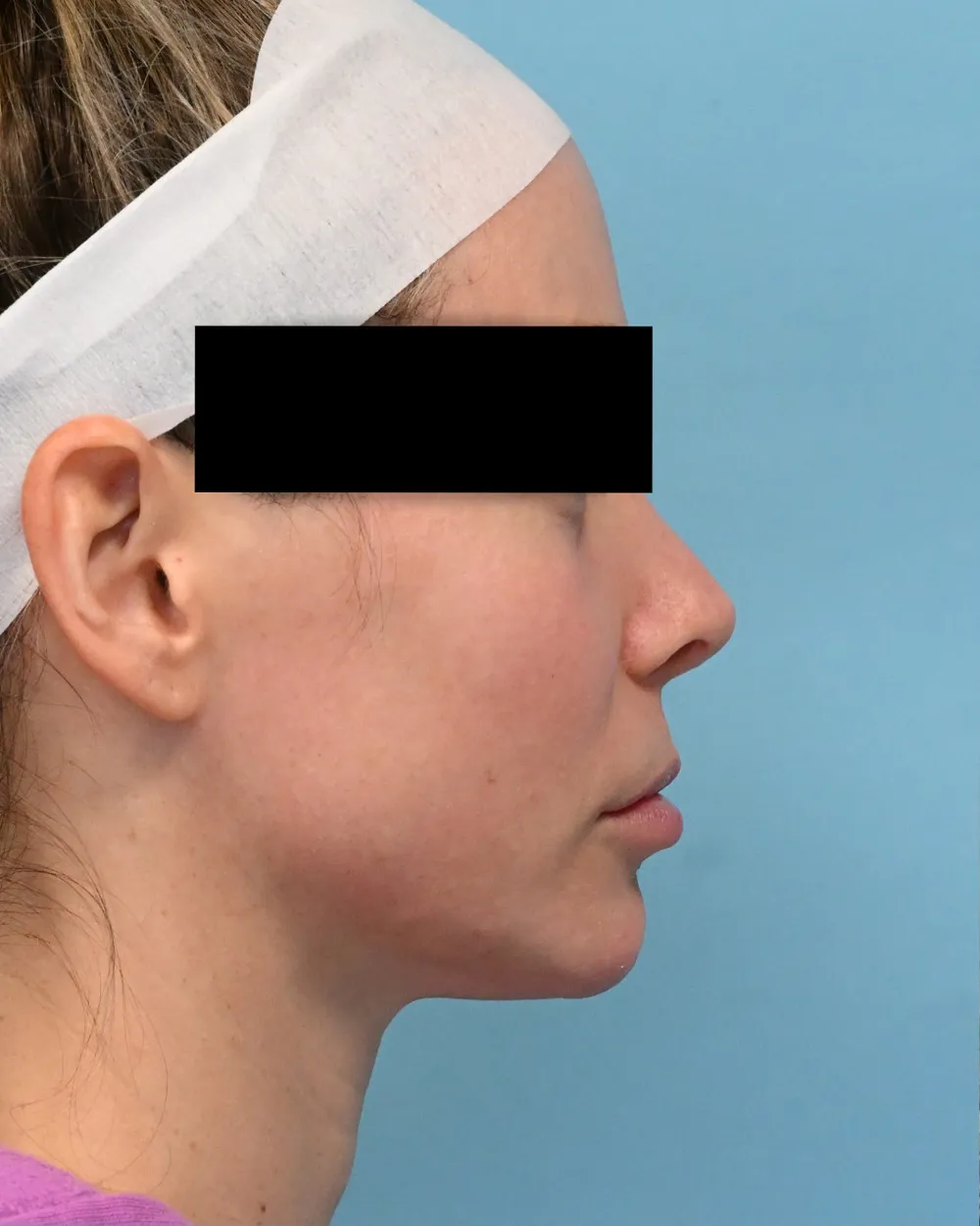 p3-liplift-03