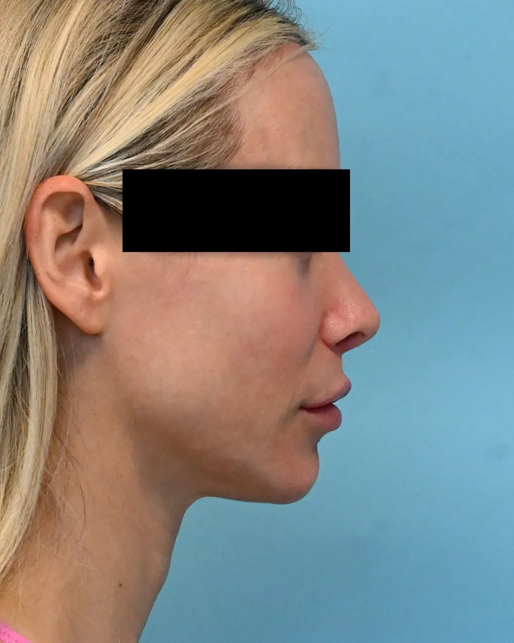 p3-liplift-03a