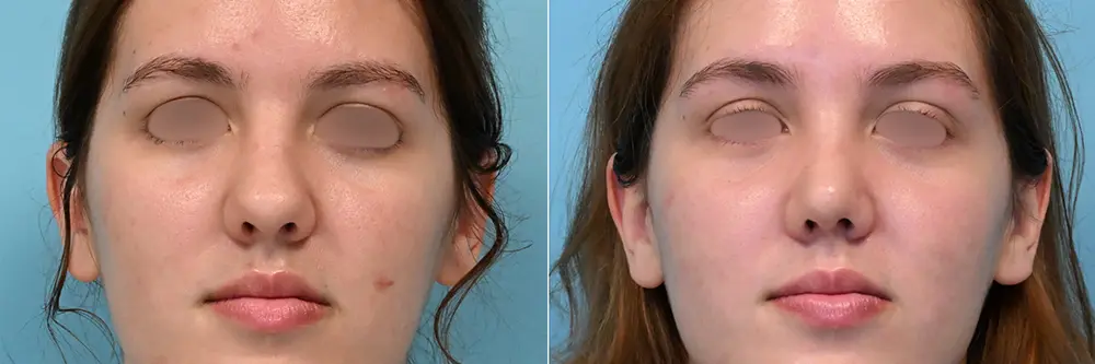 rhinoplasty-08-01