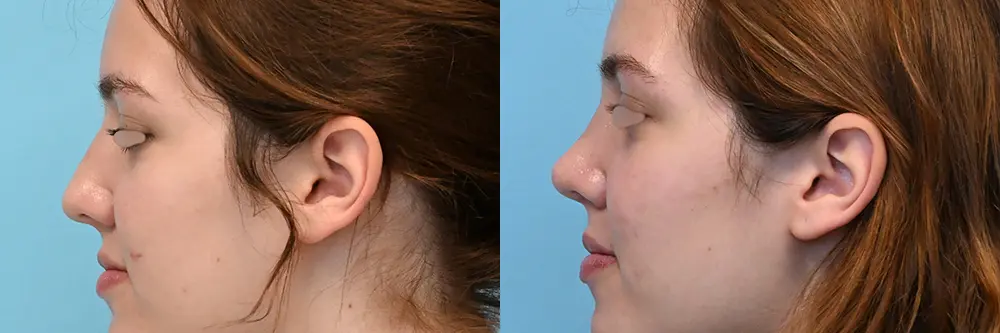 rhinoplasty-08-02