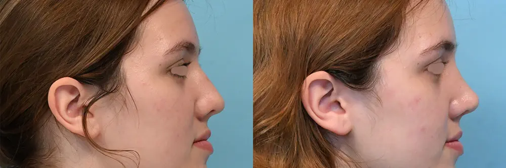 rhinoplasty-08-03